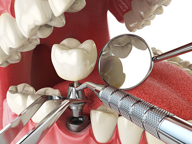 Best Emergency Root Canal Treatment in Highland Park, IL
